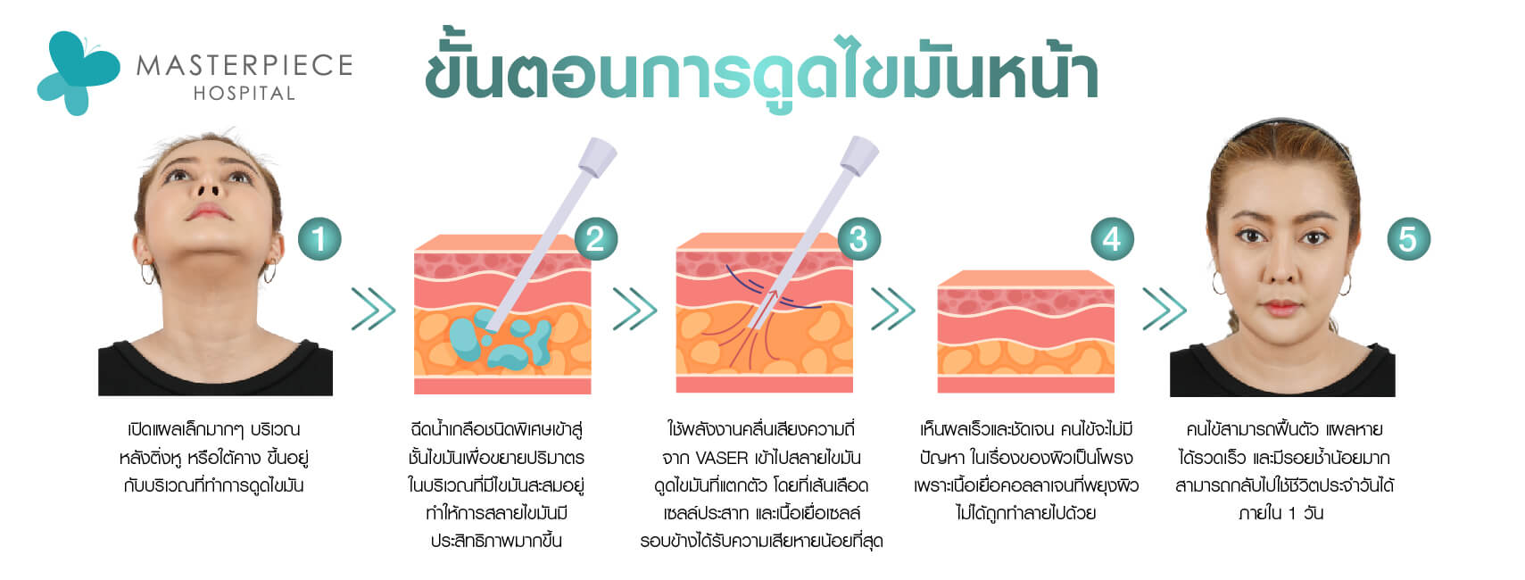 ขั้นตอนการดูดไขมันหน้า 
1. ผู้หญิงเงยหน้าขึ้นให้เห็นบริเวณที่จะดูไขมันเหนียง
2. จำลองชั้นผิวหนังและเข็มฉีดยาฉีดน้ำเกลือเพื่อเตรียมการดูดไขมัน
3. จำลองชั้นผิวหนังไขมัน ใช้คลื่นเสียงความถี่จากเครื่อง Vaser เข้าไปสลายไขมันโดยเส้นเลือดและเซลล์ประสาทได้รับความเสียหายน้อยที่สุด
4. จำลองชั้นผิวหนังและไขมันหลังทำการดูไขมัน เห็นผลชัดเจน
5. ผู้หญิงหน้าตรงเหนียงลดจนแทบไม่เห็น แผลหายไว พักฟื้น 1 วัน