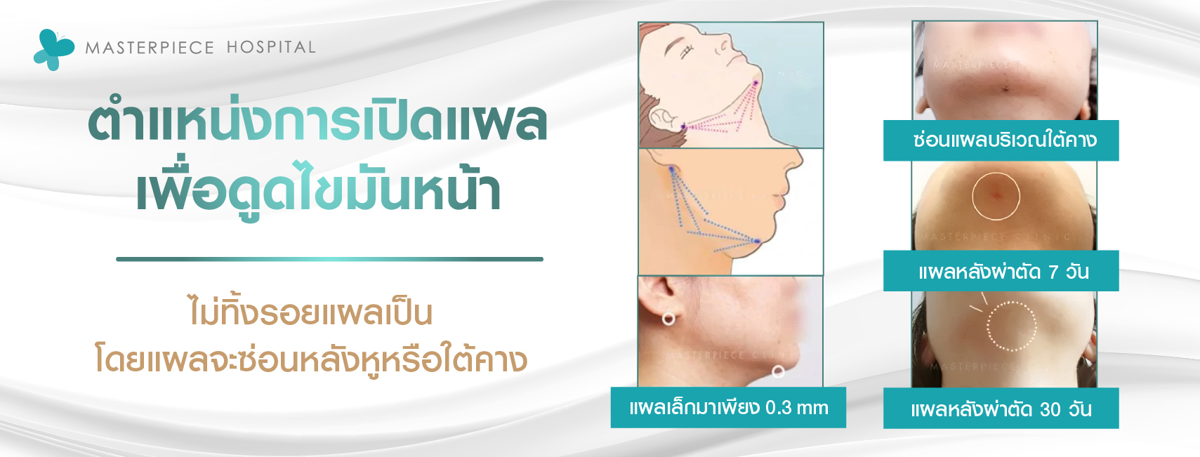 จะลองแผลการดูดไขมันหน้าบริเวณใต้คาง แผลเล็กประมาณ 0.3 mm แผลจะหายสนิทใน 30 วัน