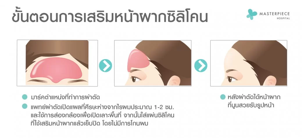 ขั้นตอนการเสริมหน้าผากด้วยซิลิโคน