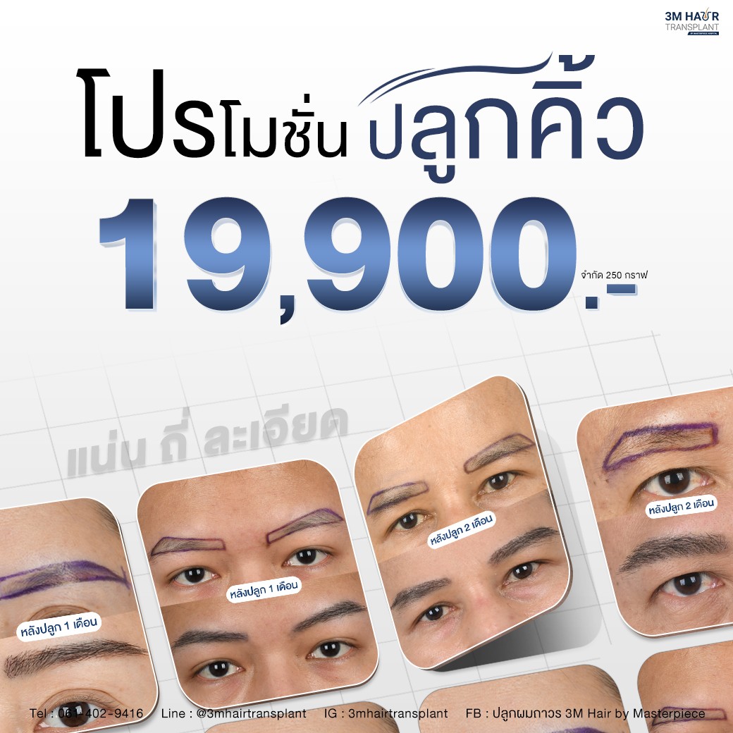 ปลูกคิ้วถาวร 19900 จำกัดที่ 250 กราฟ