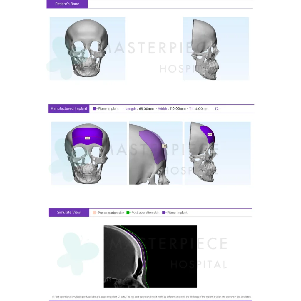 ซิลิโคนสั่งทำพิเศษเฉพาะบุคคล (3D Customized Silicone) จากประเทศเกาหลีใต้