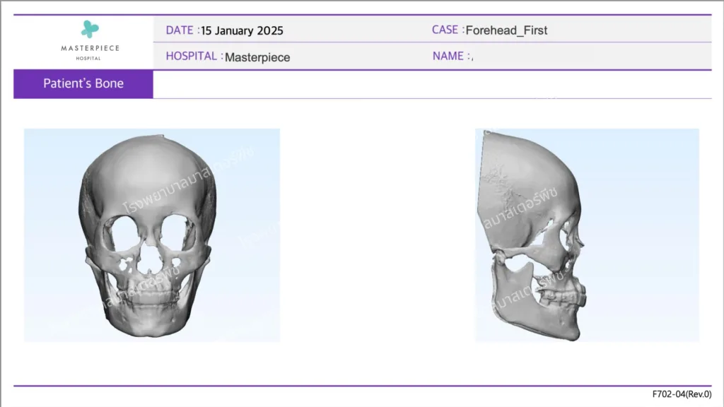 ขั้นตอนการออกแบบ ซิลิโคนสั่งทำพิเศษเฉพาะบุคคล (3D Customized Silicone)