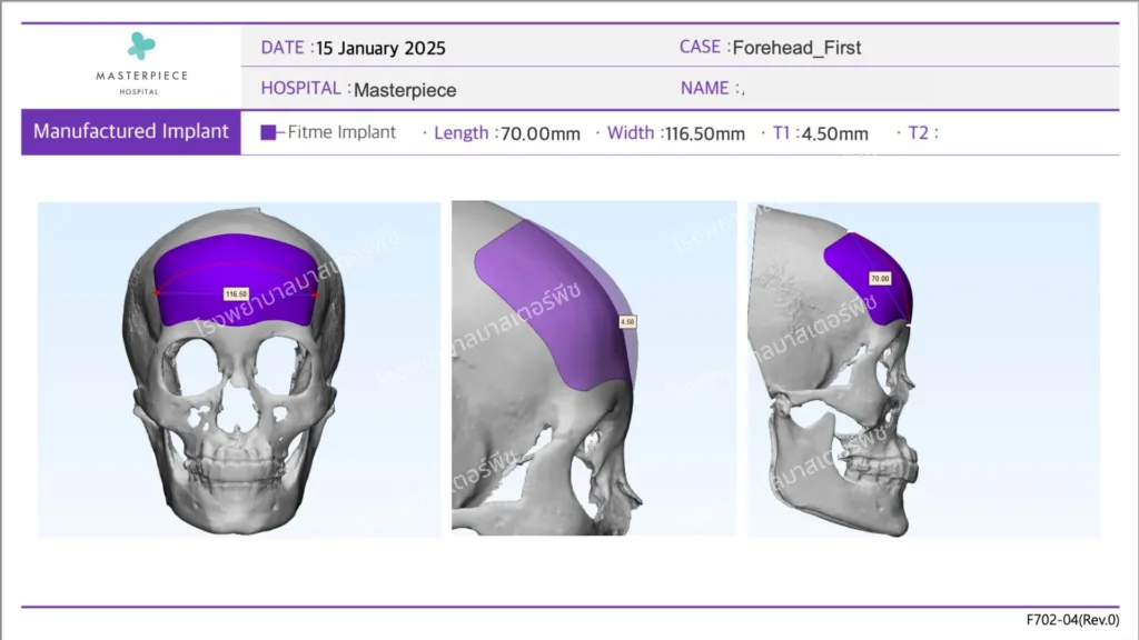 ขั้นตอนการออกแบบ ซิลิโคนสั่งทำพิเศษเฉพาะบุคคล (3D Customized Silicone) ที่โรงพยาบาลมาสเตอร์พีช 2