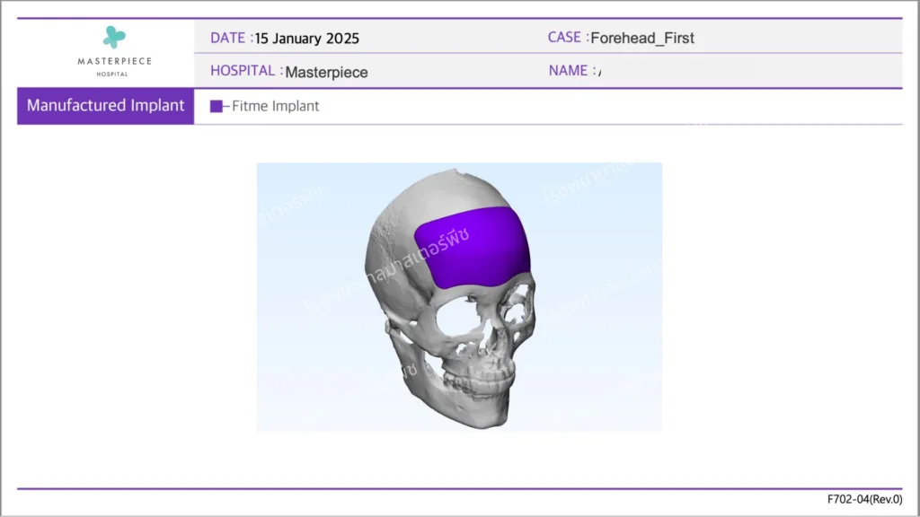 ขั้นตอนการออกแบบ ซิลิโคนสั่งทำพิเศษเฉพาะบุคคล (3D Customized Silicone) ที่โรงพยาบาลมาสเตอร์พีช 3