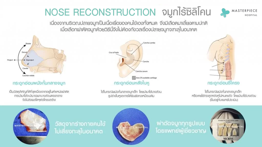 NOSE RECONSTRUCTION จมูกไร้ซิลิโคนโดยจะมีการใช้กระดูกอ่อนในร่างกายมาเสริมแทนซิลิโคน