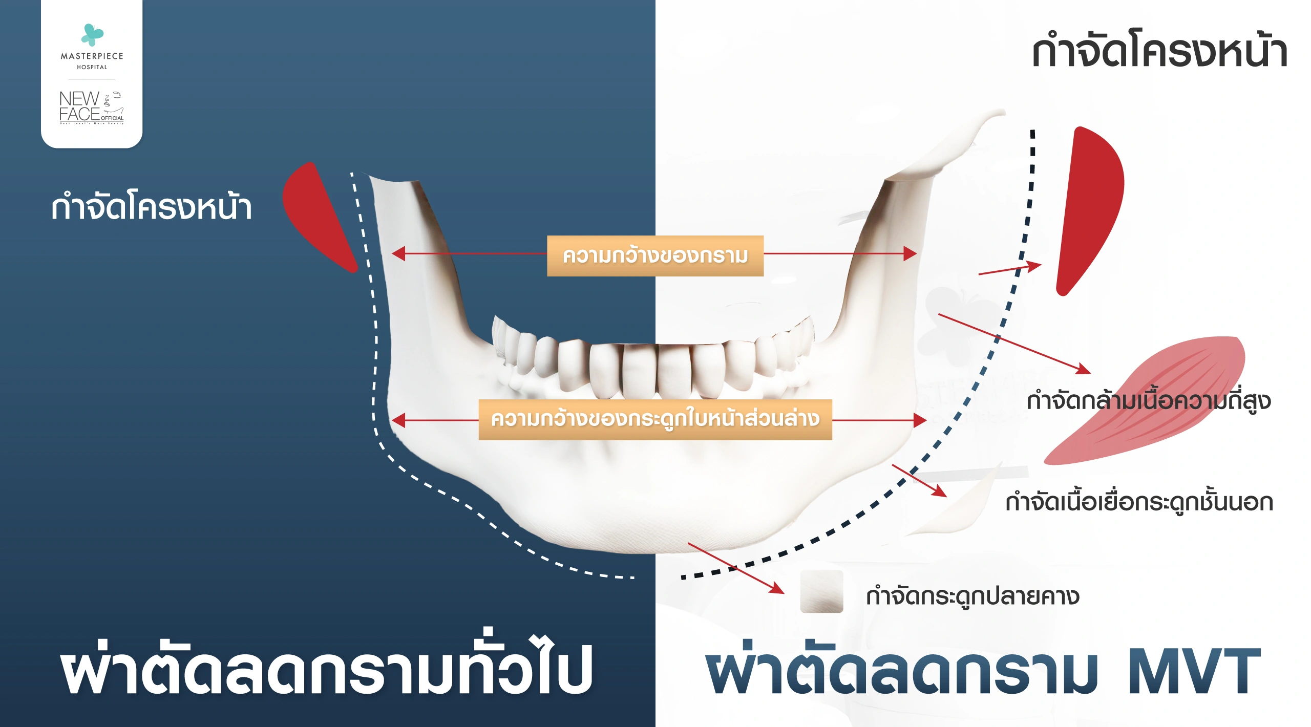 ผ่าตัดลดกราม mvt