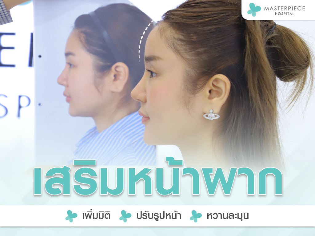 เสริมหน้าผากที่มาสเตอร์พีช