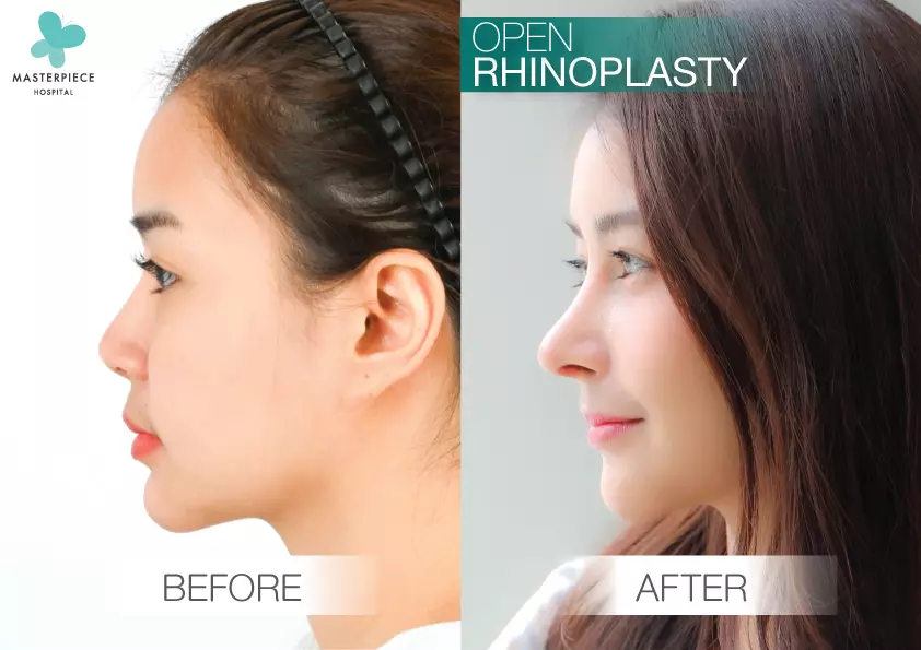 รีวิวเสริมจมูกแบบ open rhinoplasty