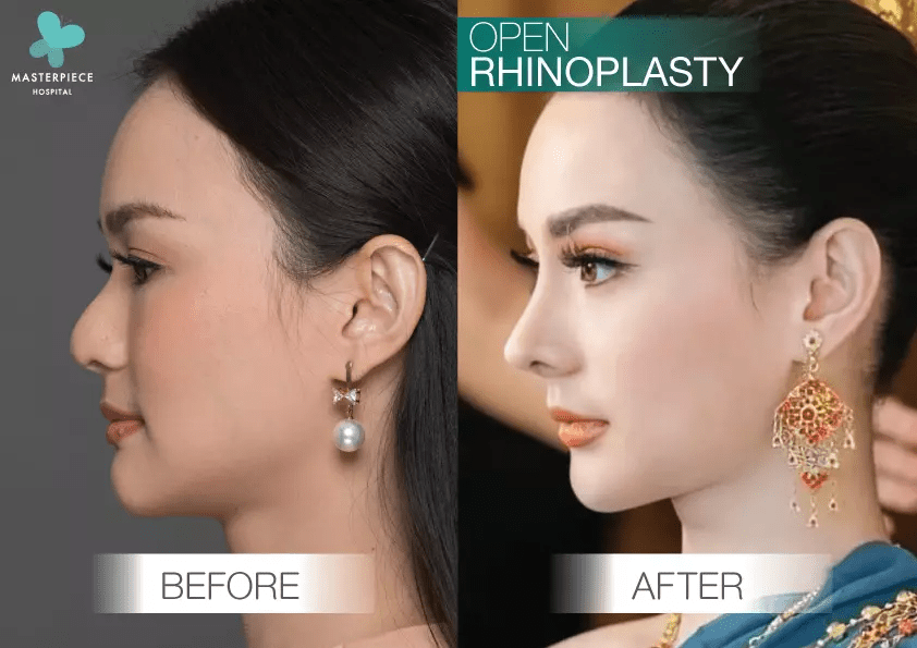 รีวิวเสริมจมูกแบบ open rhinoplasty