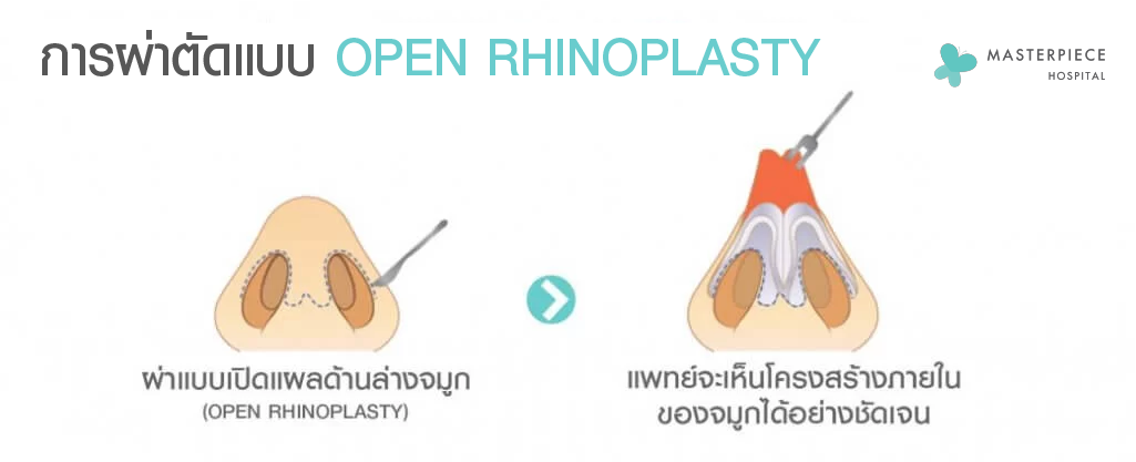 การผ่าตัดแบบ OPEN RHINOPLASTY จะแสดงให้เห็นถึงลักษณะการผ่าเปิดจมูก