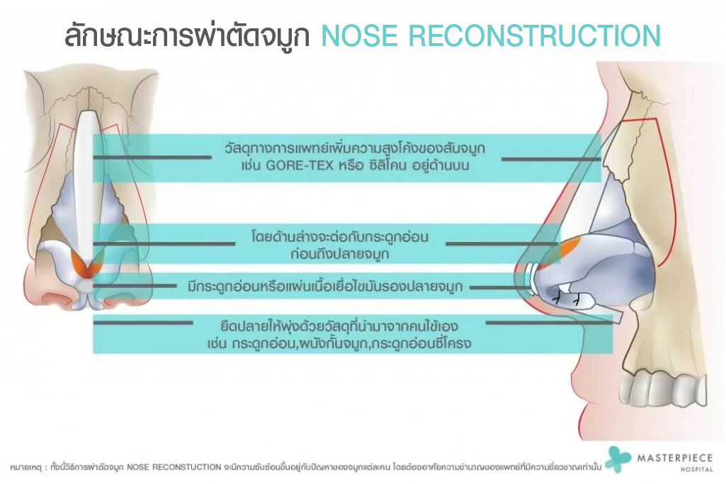 ลักษณะการผ่าตัดจมูก NOSE RECONSTRUCTION 