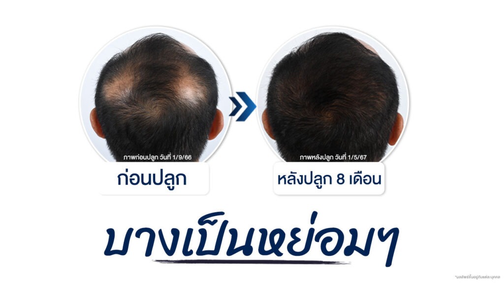 รีวิวปลูกผมที่โรงพยาบาลมาสเตอร์พีชไปแล้ว 8 เดือน