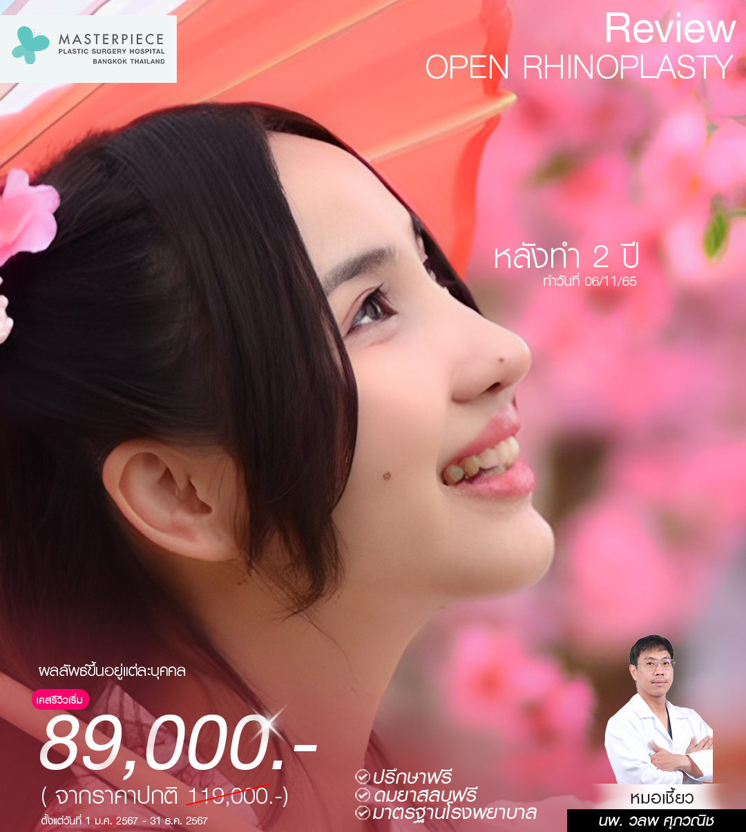 รีวิว open rhinoplasty กับหมอเชี้ยว