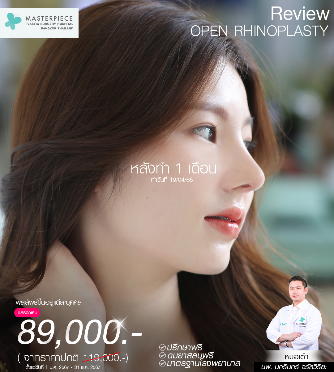 รีวิว open rhinoplasty กับหมอเต๋า