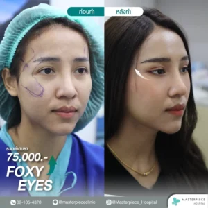 รีวิวศัลยกรรมยกหางตา Foxy eye แก้หางตาตก เปลี่ยนตาเศร้า หน้าแก่ให้เป็นตาเซ็กซี่ หน้าเด็กได้อย่างเห็นได้ชัด