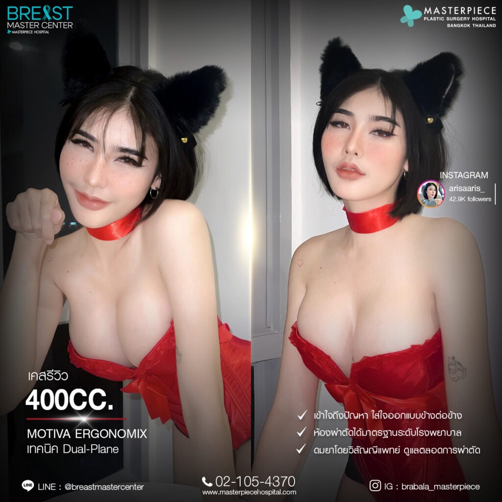 รีวิวเสริมหน้าอก 450 CC