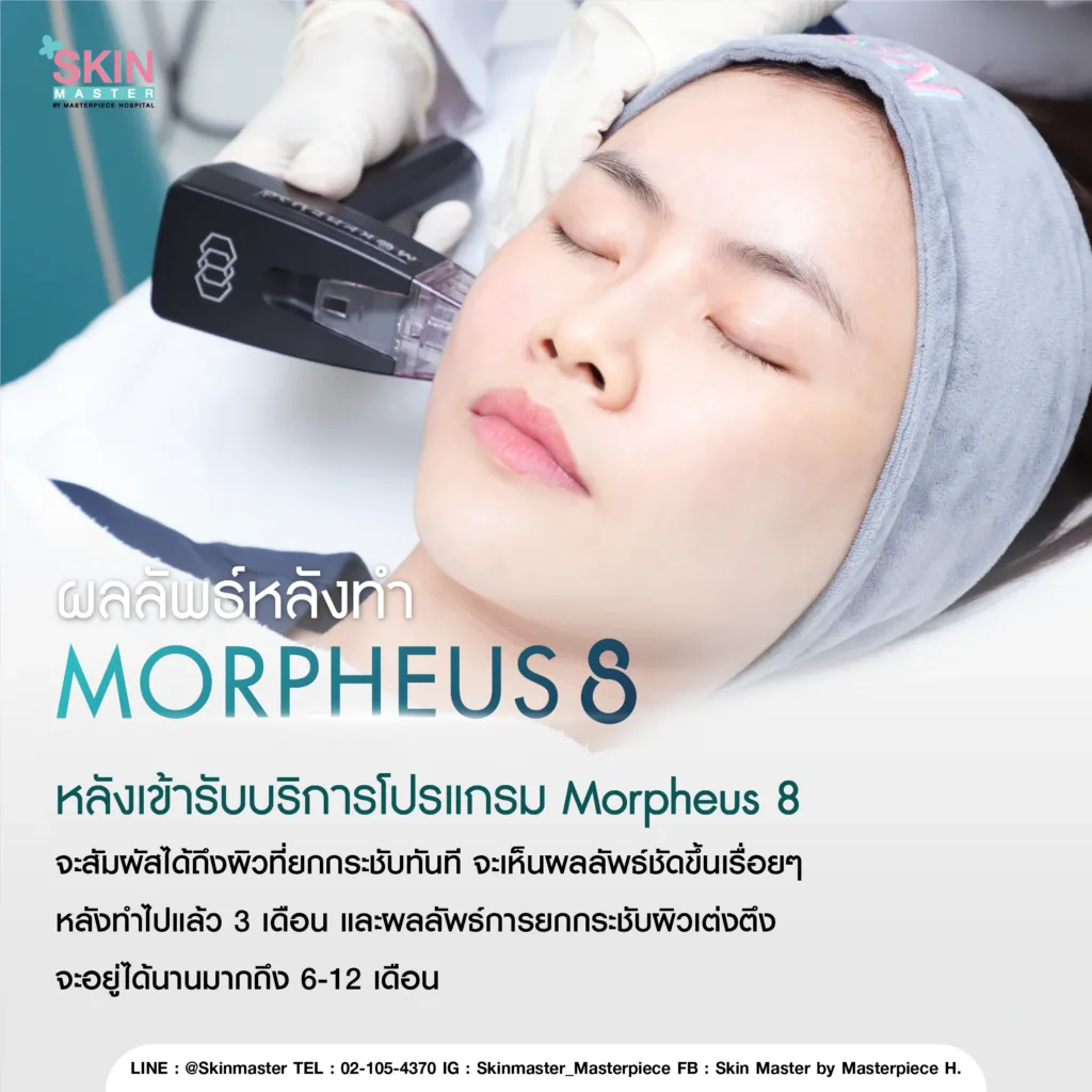 ผลลัพธ์หลังทำ มอเฟียส 8 ( MORPHEUS8 ) 