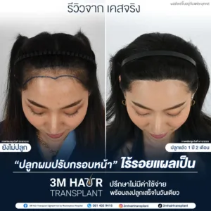 B&A ปลูกผม โรงพยาบาลมาสเตอร์พีช