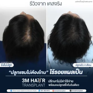 B&A ปลูกผม โรงพยาบาลมาสเตอร์พีช