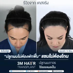 B&A ปลูกผม โรงพยาบาลมาสเตอร์พีช