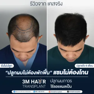 B&A ปลูกผม โรงพยาบาลมาสเตอร์พีช