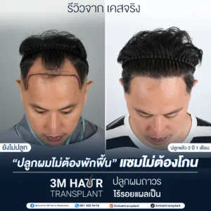 B&A ปลูกผม โรงพยาบาลมาสเตอร์พีช