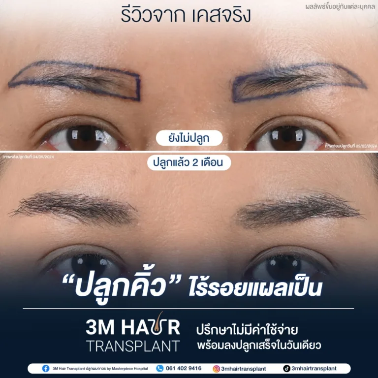 B&A ปลูกคิ้ว โรงพยาบาลมาสเตอร์พีช