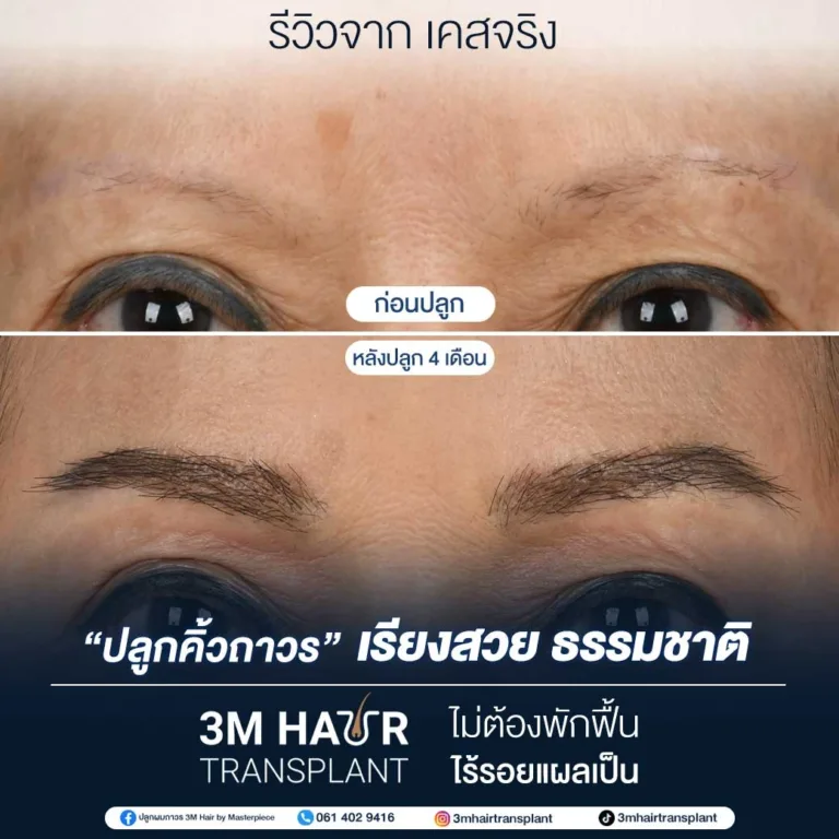 B&A ปลูกคิ้ว โรงพยาบาลมาสเตอร์พีช