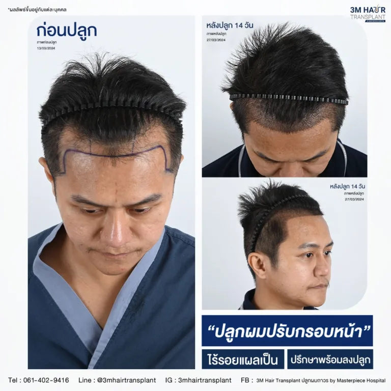 B&A ปลูกผม โรงพยาบาลมาสเตอร์พีช