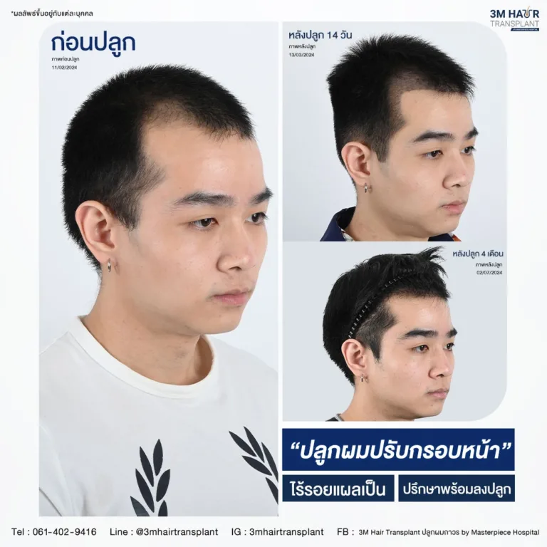 B&A ปลูกผม โรงพยาบาลมาสเตอร์พีช