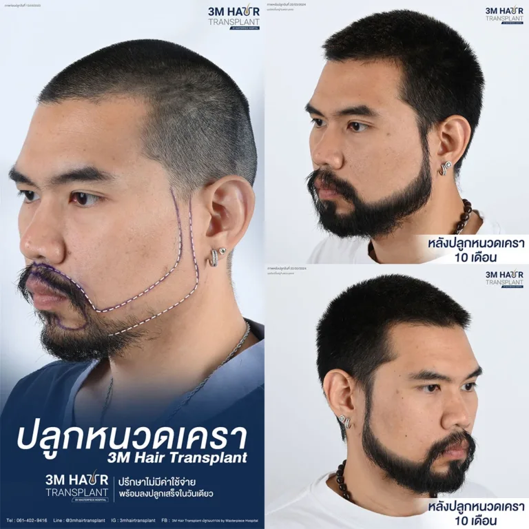 B&A ปลูกหนวดเครา โรงพยาบาลมาสเตอร์พีช