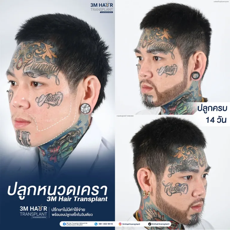 B&A ปลูกหนวดเครา โรงพยาบาลมาสเตอร์พีช