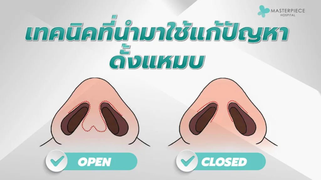 เทคนิคที่นำมาใช้แก้ปัญหา ดั้งแหมบ