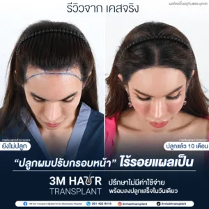 Before & After ปลูกผม แก้ปัญหาศีรษะล้าน ผมบาง ทำให้ผมหนาขึ้น