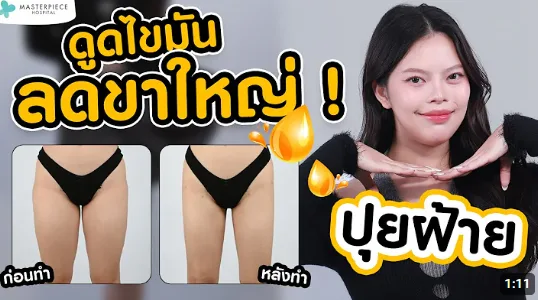 vdoดูดไขมันลดขาใหญ่ที่โรงพยาบาลมาสเตอร์พีชรีวิวจากคุณปุยฝ้าย