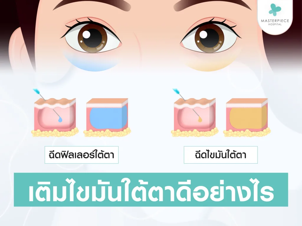 เติมไขมันใต้ตาดีอย่างไร