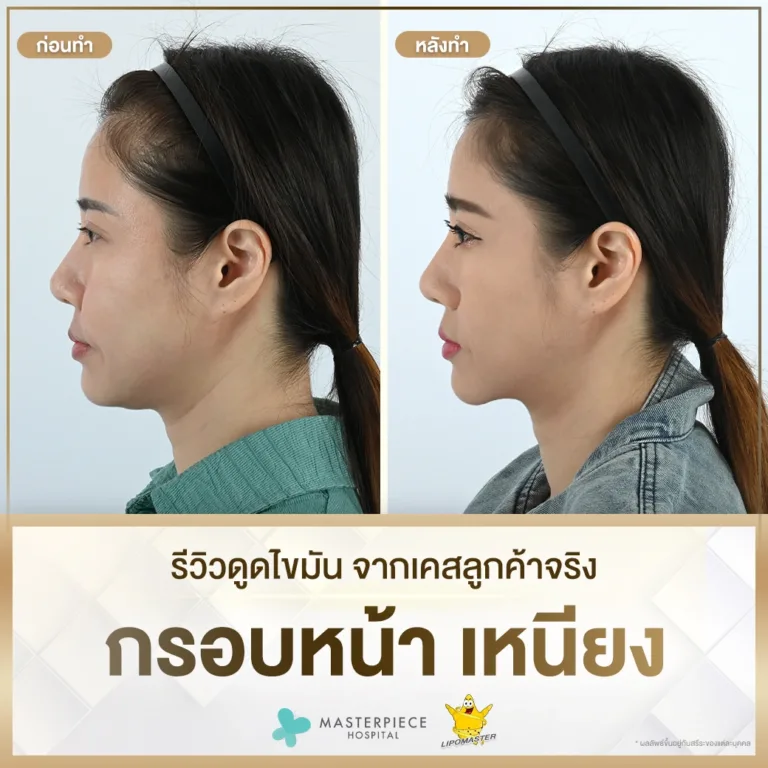 รีวิวดูดไขมันกรอบหน้าเหนียง 06 19 ก.ย. 67