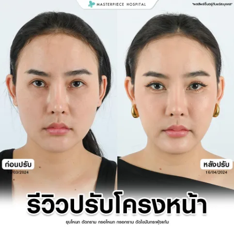 รีวิวปรับโครงหน้า คนที่1