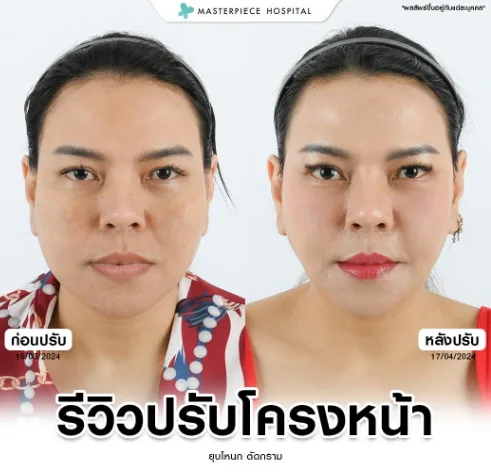 รีวิวปรับโครงหน้า คนที่2