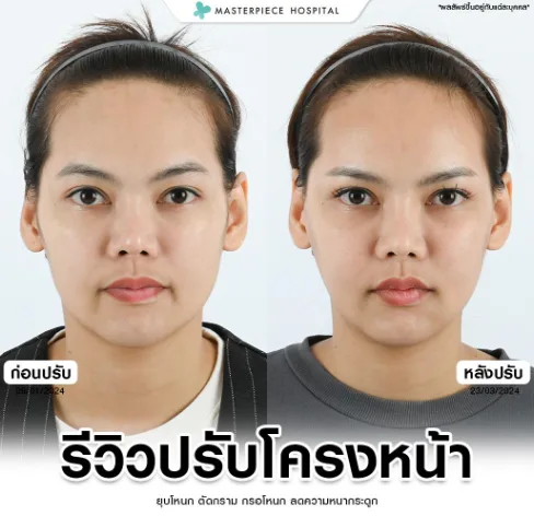 รีวิวปรับโครงหน้า คนที่3