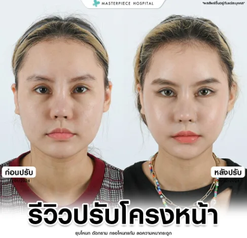 รีวิวปรับโครงหน้า คนที่4