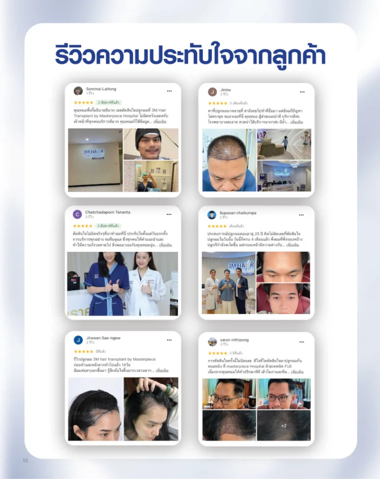 รีวิวความประทับใจปลูกผมจากลูกค้า