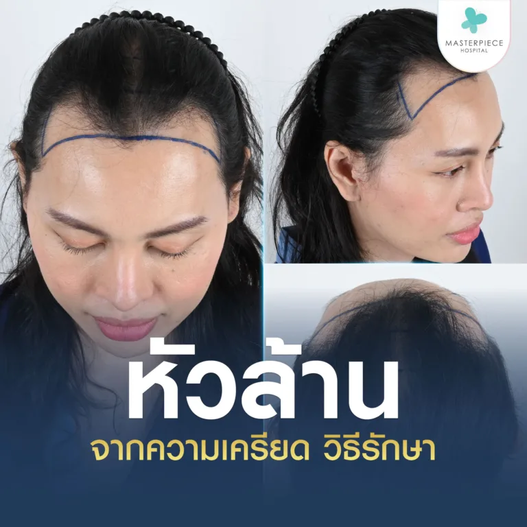 หัวล้าน จากความเครียด สาเหตุและวิธีรักษา