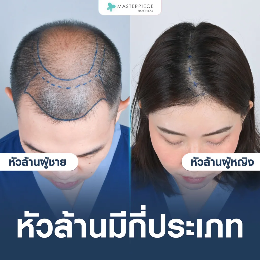 หัวล้านมีกี่ประเภท?