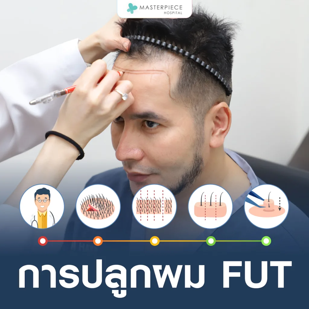 ขั้นตอนการปลูกผม FUT