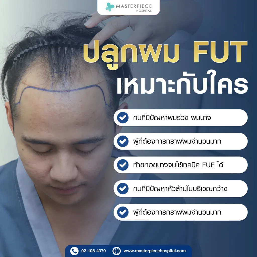 การปลูกผม FUT เหมาะสำหรับใคร?