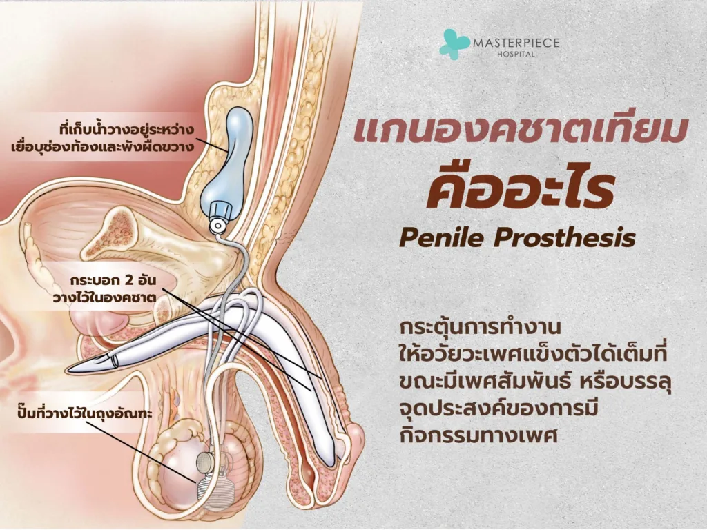 penileprosthesis