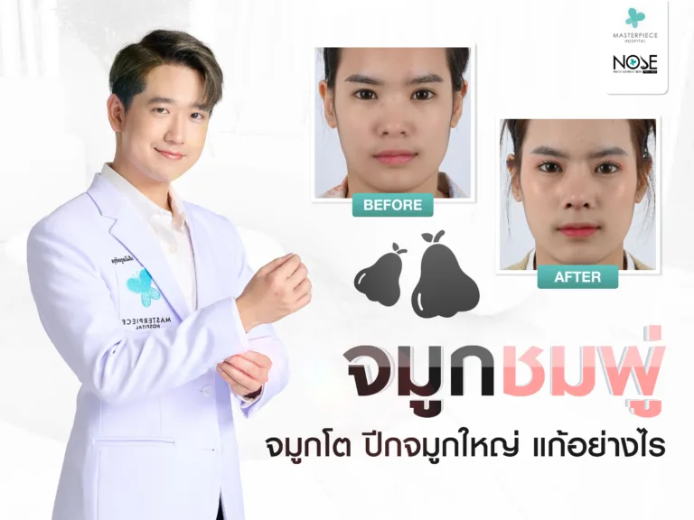 จมูกชมพู่ จมูกโต ปีกจมูกใหญ่ แก้ได้อย่างไรบ้าง