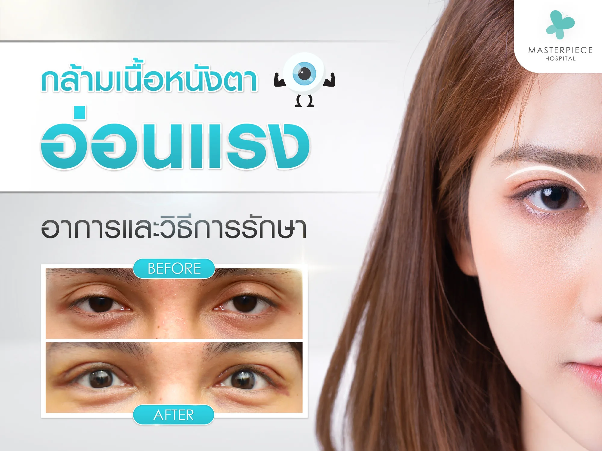 กล้ามเนื้อตาอ่อนแรง
