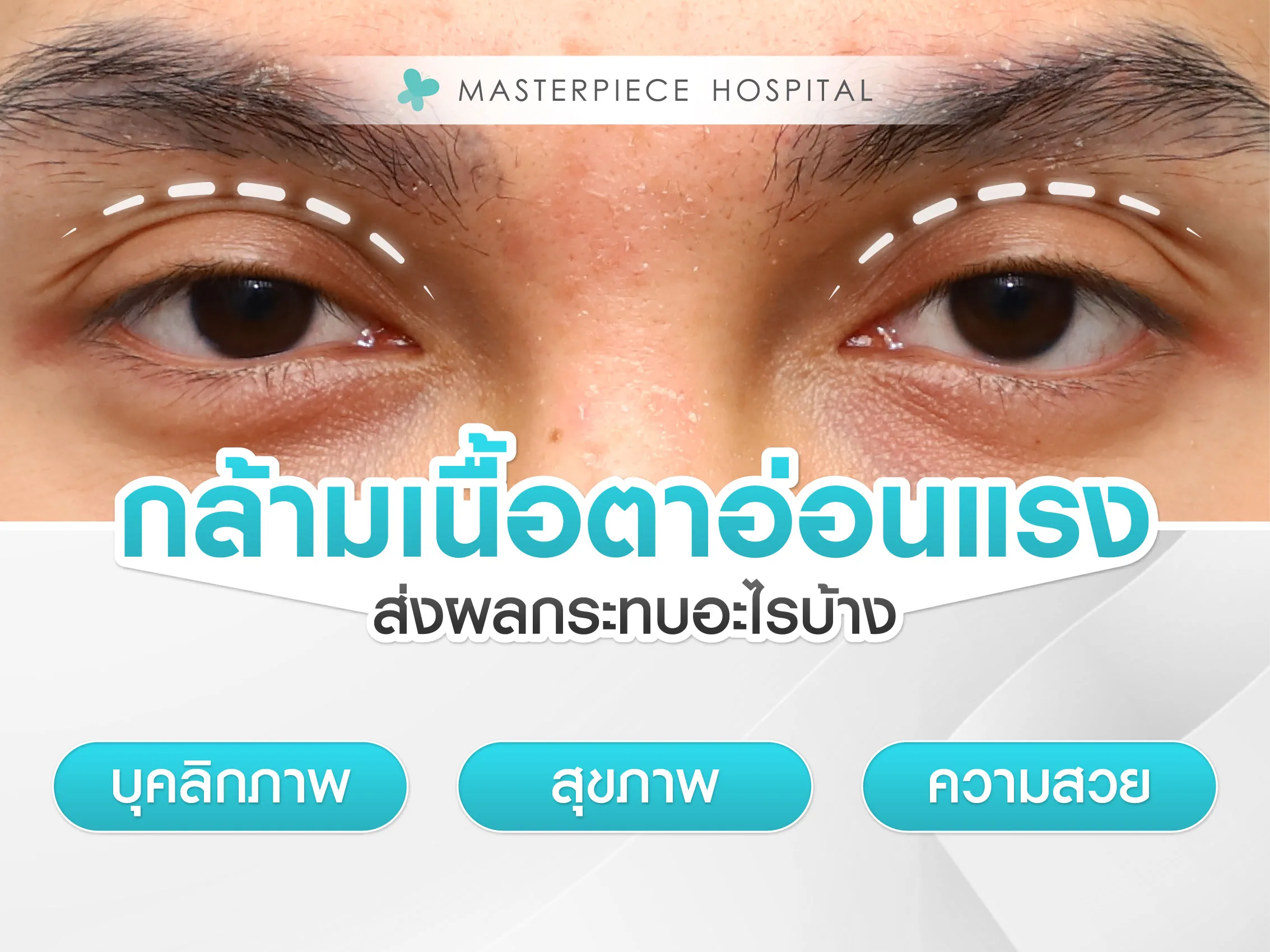ผลกระทบของอาการกล้ามเนื้อตาอ่อนแรง